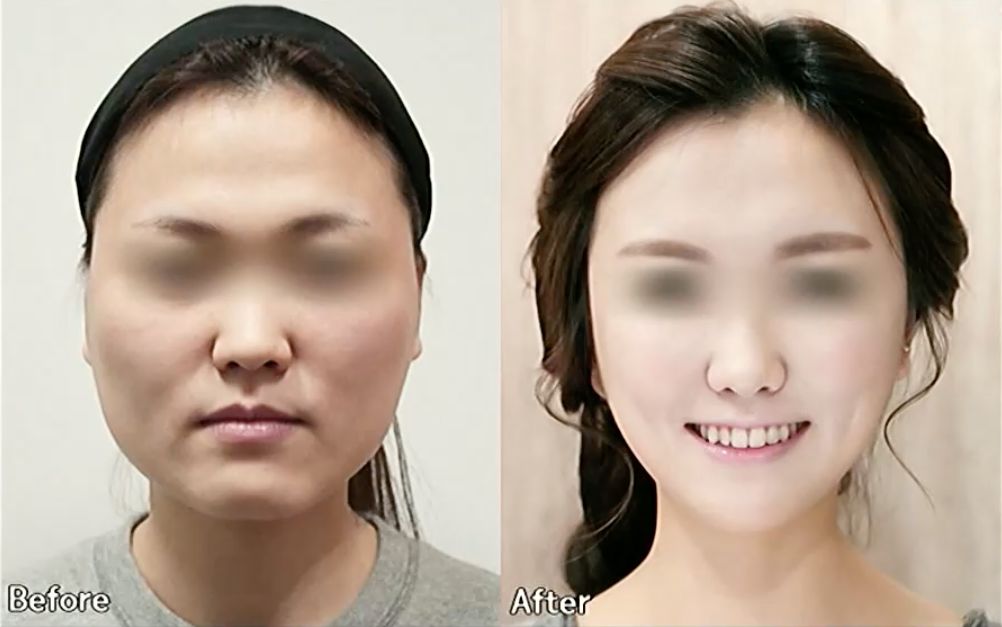 韩整容失败的中国女孩5.jpeg