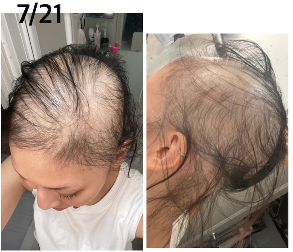 她7月中开始购买假发