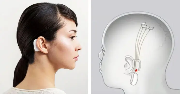 Neuralink 的脑机接口技术在实用性上更进一步